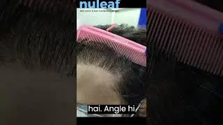 Hair Transplant Hair Line Defects Errors Unnatural Hairline design
