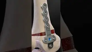 Distal femur surgery #femur #osteotomy #orthopedics #surgery