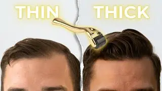 Derma Roller for HAIR LOSS RESULTS (Shocking Results)