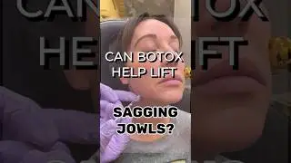 The use of Botox to treat sagging jowls! #saggyjowls #jowls #aesthetics #agelessbeauty #antiaging