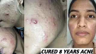 Cured 8 years of Hormonal Acne #acne #acnescars #skincareroutine