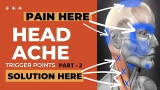 TRIGGER POINT SERIES - PART 2 | TRIGGER POINT EXPLAINED |  TENSION HEADACHE | STRESS HEADACHE