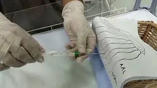 Using Easy drain for chest intubation in Neonates