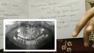 Regional odontodysplasia | Ghost teeth | NEET PG MDS | Oral pathology