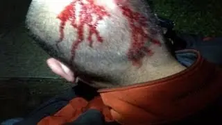 Zimmerman Injuries Seen in Exclusive Photo: Pictures from Night of Trayvon Martin's Death