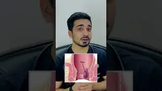 Three Important causes of Piles or hemorrhoids.