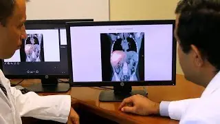 TARE procedure available for pediatric liver cancer patients at Texas Children's Hospital