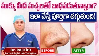 How to Remove Nose Tan and Dark Spots Fast | Clear Skin Tips Telugu | Celestee Skin And Hair Clinic