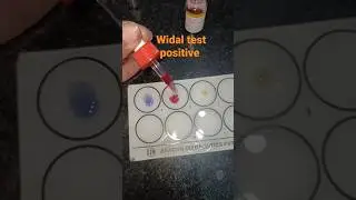 Serological practical WIDAL test #typhoidfever #trending #practical #pathology #shorts #status