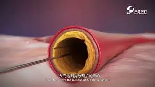Vesscide Cutting Balloon System
