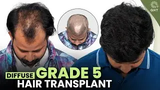 Grade 5 Hairloss | Diffuse Grade 5 Hair Transplant | Grade 5 Hair Transplant | Grade 5 | QHT | 2026