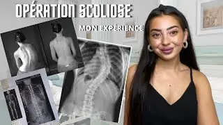 OPÉRATION SCOLIOSE | MON PARCOURS 🩻👨‍⚕️