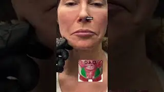 Lower Face Botox😳 | Dr. Jaluvmabody