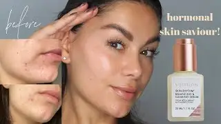 THE SERUM YOU NEED FOR HORMONAL BREAKOUTS | Beauty's Big Sister AD