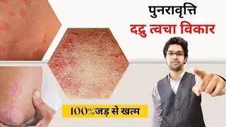 Fungal Infection Permanent Cure in HINDI With 100% Money Back Guarantee | BEST FUNGAL TREATMENT