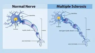 Multiple Sclerosis Explained (Whispering ASMR Tutor)