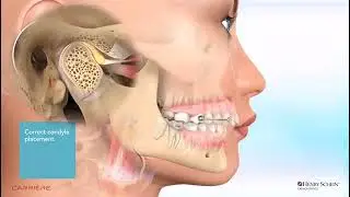 Carriere® Motion™ Appliance for Class II Patient Education Animation