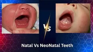 Premature eruption Vs Delayed Eruption| Natal teeth Vs NeoNatal Teeth! 