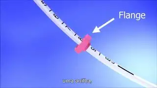 Jaydess&reg; placement, removal and replacement