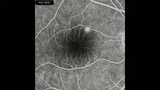 Wide field BLFI images and OCT in a case of central serous chorioretinopathy (CSC)