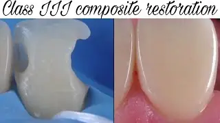 Class III composite Restoration || anterior composite restoration