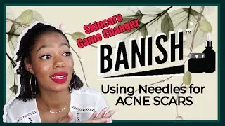 Using Banish for ONE Month! | At home tools to get rid of Acne Scars!