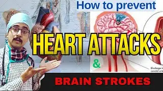 Heart Attack Prevention: Top Tips For Avoiding Brain Stroke Or Heart Attack
