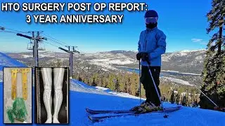 HTO High Tibial Osteotomy 3 Years Post Op Skiing at Age 62