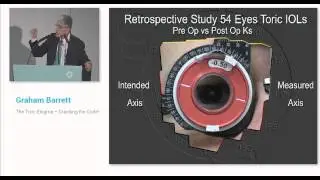 ESCRS 2014 BARRETT from HAAG STREIT DIAGNOSTICS on Vimeo