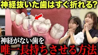 虫歯治療で神経を取った歯って5年後どうなるの？長持ちさせる人の共通点