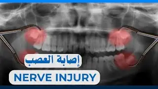 إصابة العصب أثناء الخلع الجراحي| Inferior Alveolar Nerve Injury in Impacted Wisdom
