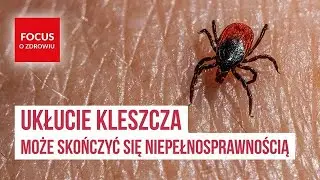 Ukłucie kleszcza może skończyć się niepełnosprawnością. Szczepimy się! | Focus o zdrowiu