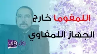 تشخيص وعلاج الليمفوما خارج الجهاز الليمفاوي