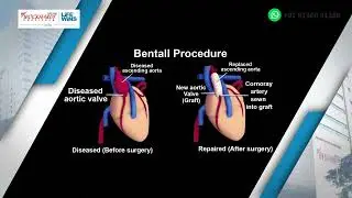 Aortic Root Replacement with Tissue prosthesis ( Bio-Bentall )