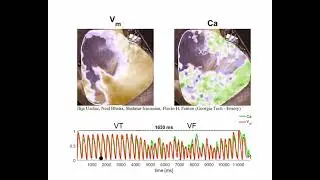 Researchers map rotating spiral waves in live human hearts