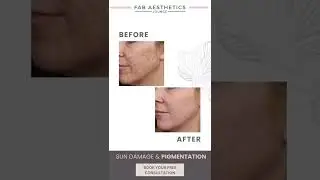SUN DAMAGE & PIGMENTATION TREATMENTS BOLTON & BURY BY FAB AESTHETICS LOUNGE