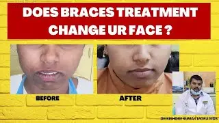 How Braces Actually Change Your Face (Before & After) #Dr KISHORE KUMAR MORA MDS#hyderabad