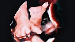 Ectrodactyly fetal ultrasound