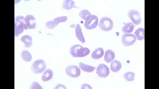 Sickle Cell Crisis Blood Film