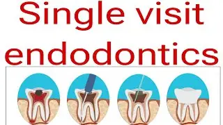 Single visit endodontics(SVE). Indications and contraindications of single visit endodontics.