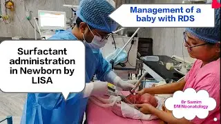 Surfactant administration in RDS by LISA|Newborn miracle