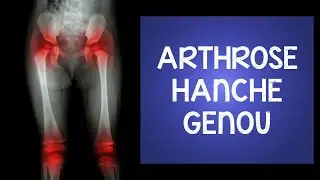Arthrose au genou et à la hanche : des exercices étonnants