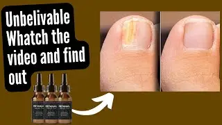 Metanail Serum Pro Walmart ⛔️❗️Metanail Serum Pro Amazon ⛔️❗️ Metanail Complex Review