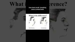 mouth breathing  it can change human face
