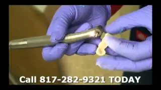 Part 12 Dr. Kyle Eberlein DDS Assistant Removes Rough Areas On Temporary Bridge