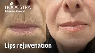 Lips rejuvenation - 23255