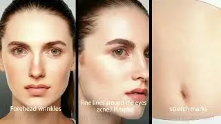 best microneedling RF machine for home and commercial use