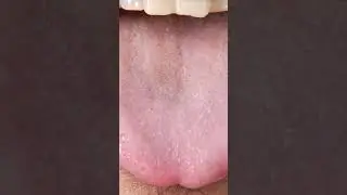 Dry Mouth (6 Basic & Easy Things To Know)