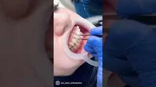 Ceramic Braces bonding