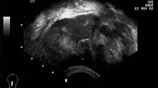 Morgagni cyst assosiated with tubal fimbria.TVUS modified by dr. Volodymyr Doshchechkyn